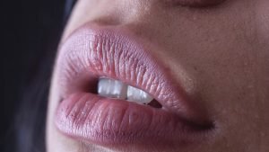 lip lifting labbro superiore filippello.it