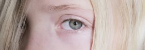oculoplastica bambini minori dai 3 anni