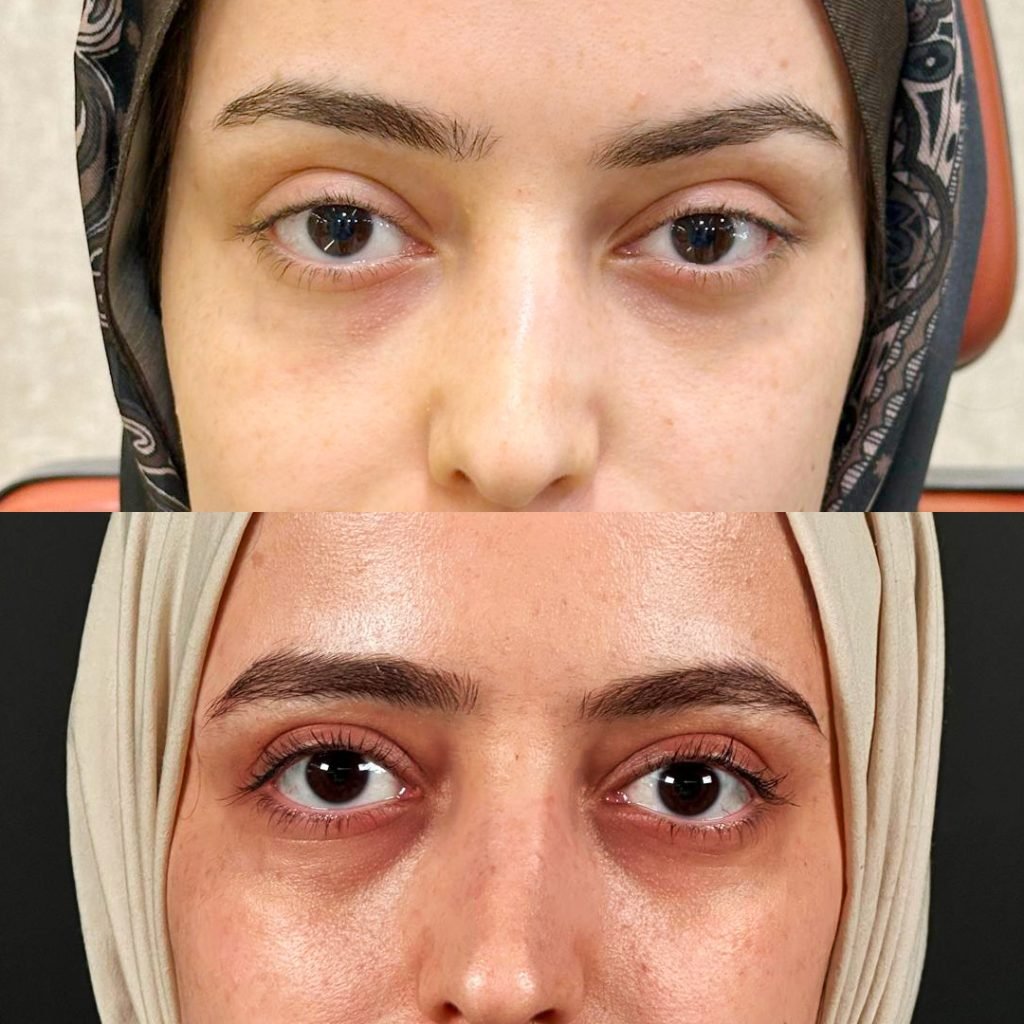 Temporal lifting endoscopico prima e dopo