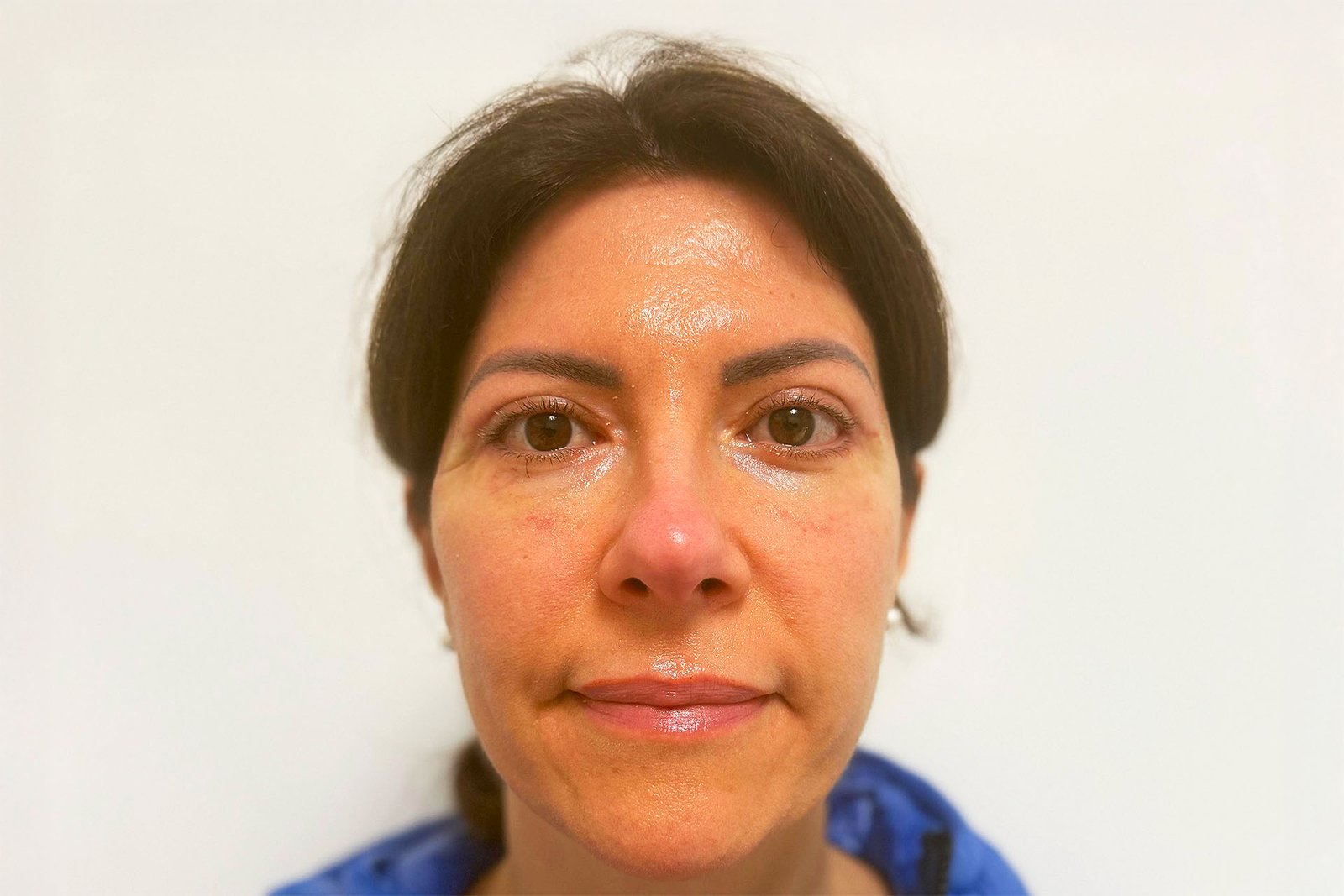 blefaroplastica superiore e inferiore con lipofilling dopo blefaroplastica superiore e inferiore con lipofilling dopo