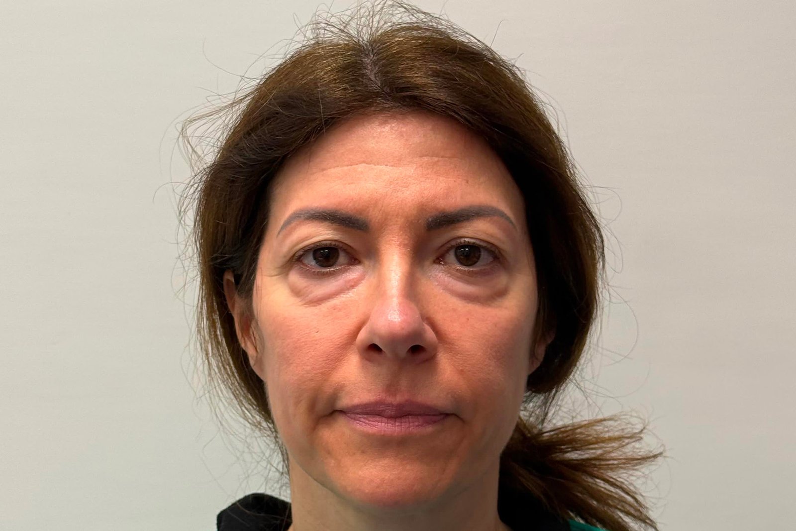 blefaroplastica superiore e inferiore con lipofilling prima blefaroplastica superiore e inferiore con lipofilling prima